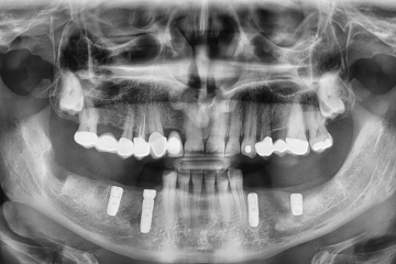 Prednosti zobnega implantata