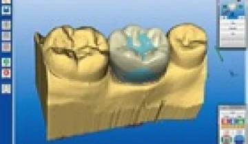 Cerec 3D protetika (CAD/CAM tehnologija)