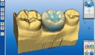 Cerec 3D protetika (CAD/CAM tehnologija)