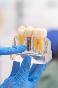 Model zob z zobnimi implantati