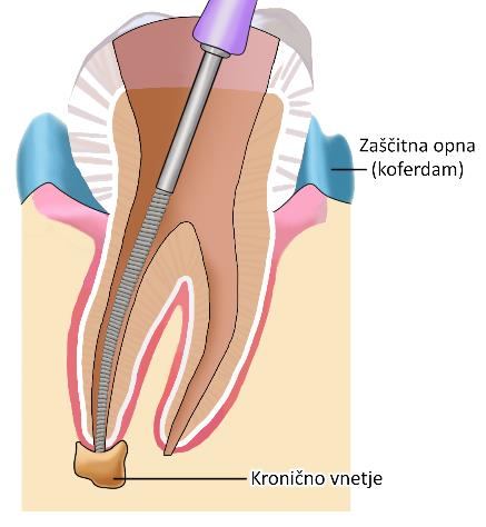 Potek koreninskega zdravljenja