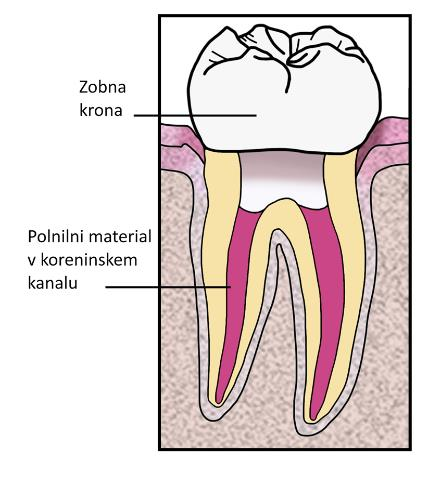Potek koreninskega zdravljenja